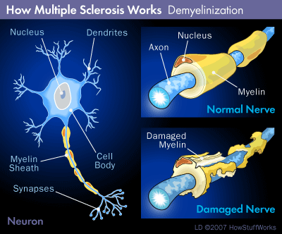 multiple sclerosis demyelinization