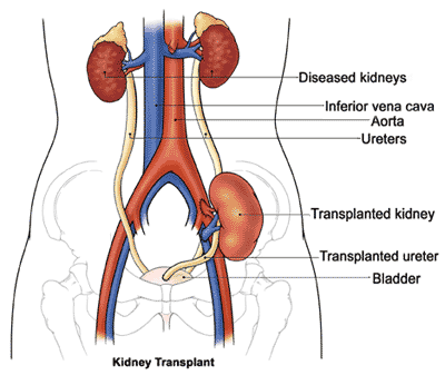 Risks of kidney transplant surgery