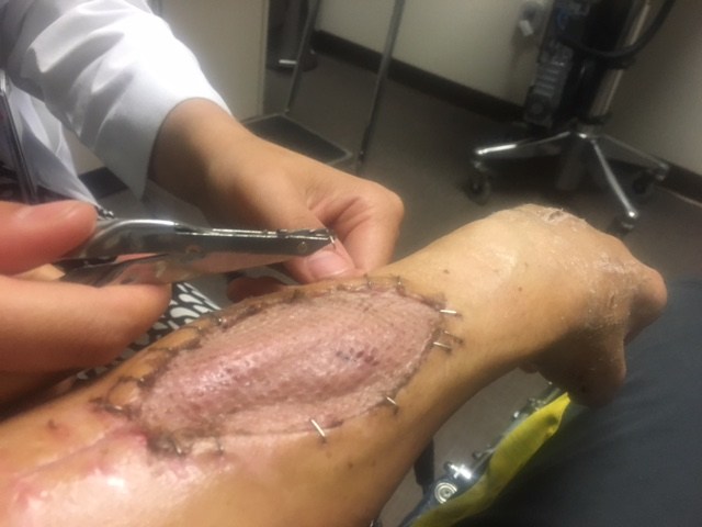 Skin graft for compartment syndrome
