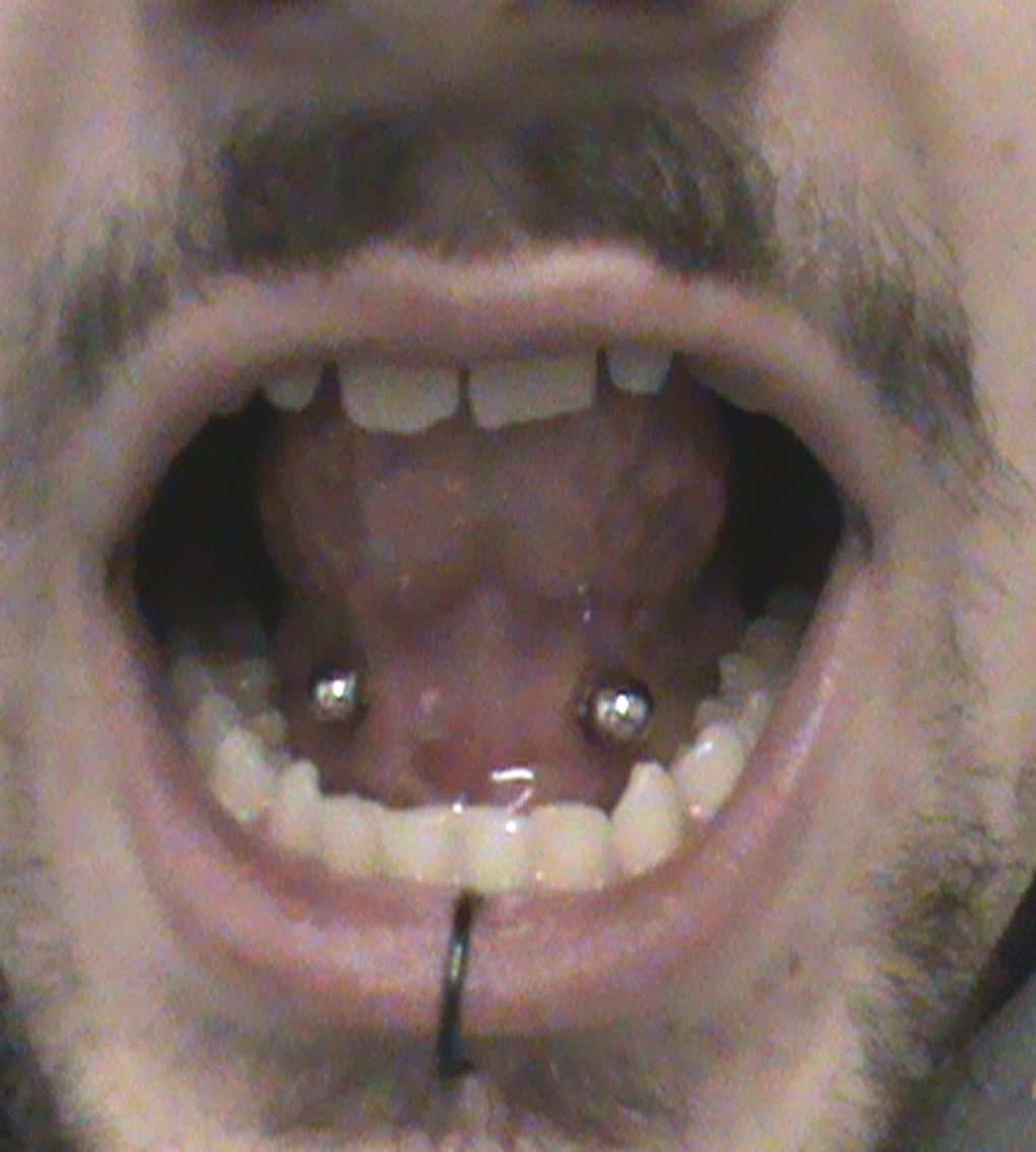 Lower Lip And Tongue Frenulum Piercing For Men