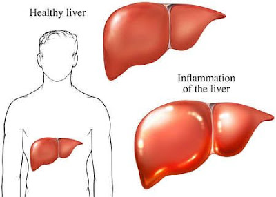 liver+inflammation - Risiko Radang Hati (Hepatitis)