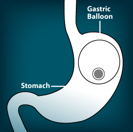 Gastric balloon, London, UK, abroad, Brussels