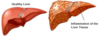 الكبد الطبيعي والكبد الملتهب