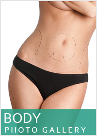 Post-Bariatric Surgery Beverly Hills