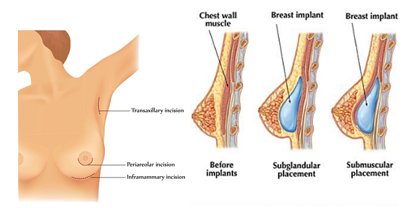 Nâng ngực nội soi với nhiều ưu điểm vượt trội
