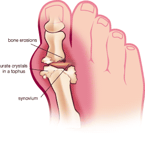 The Symptoms, Treatment of Gout