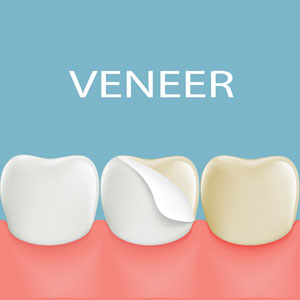 Illustration of dental veneer