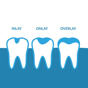 Illustration of dental inlay and onlay