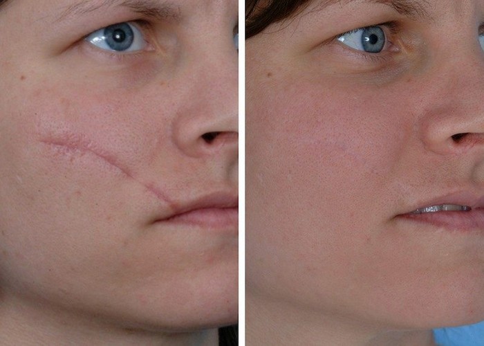 surgery-marks-and-new-acne-scars-treat-them-well-with-mederma-night-cream-scar-removal
