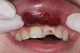 Sports Dental Injury Chipped Tooth Prevent Injury Mouthguard 