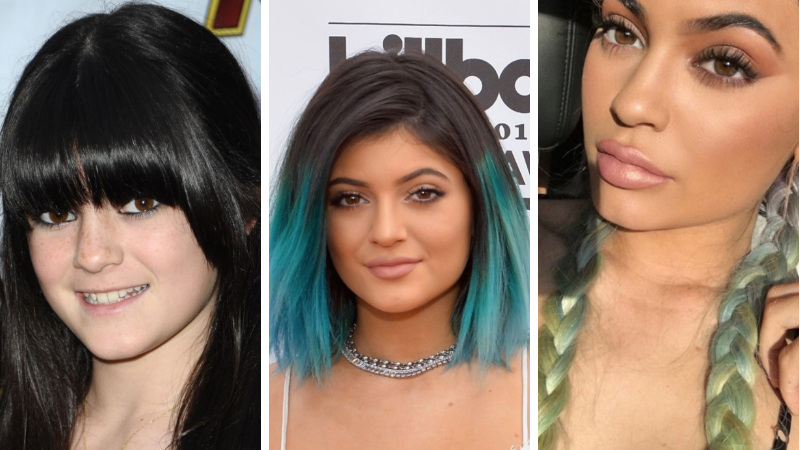 Before and After Pictures 37. kylie jenner plastic surgery kylie jenner bef...