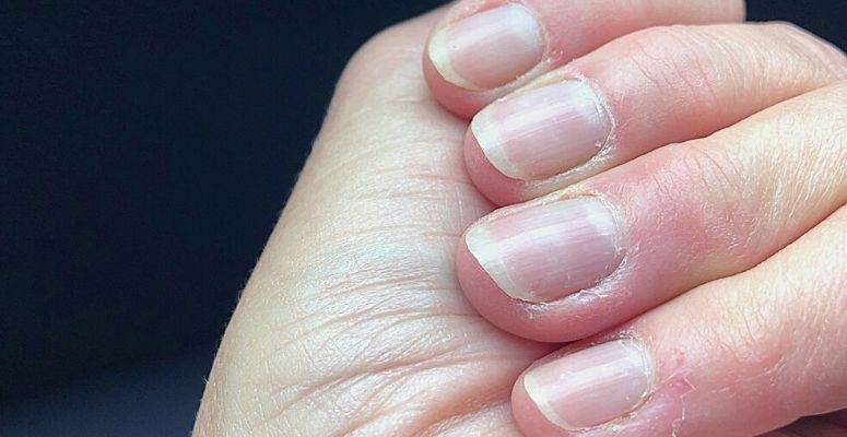 Nail ridges on aging hands 