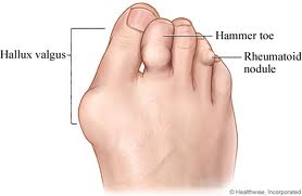 rheumatoid arthritis in the foot