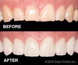 Porcelain veneers - before and after.