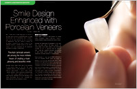 Porcelain Veneers - Dear Doctor Magazine