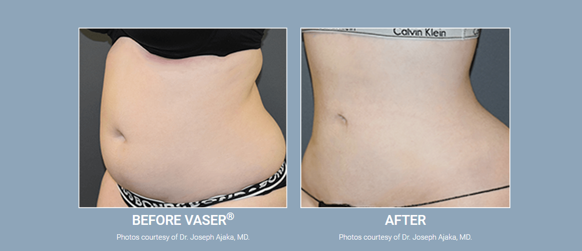 Female left flank before-and-after vaser lipo.